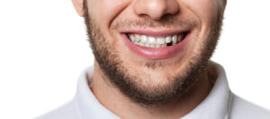 Missing Teeth